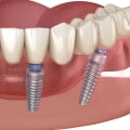 Why are full mouth implants so expensive?