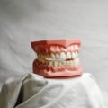 Transforming Smiles in San Diego, CA: Full Mouth Restoration Services Inspired by Dental Implants