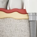 Can dental implants cause cancer?