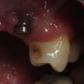 When dental implants fail?