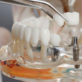 Dentist Tips And Tricks For Maintaining Your Dental Implants In Canberra