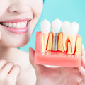 Restoring Confidence: The Importance Of Dental Implants For A Complete Smile In Ashburn