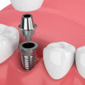 Can dental implants make you sick?