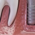 How long does it take for dental implants to stop hurting?