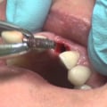 Can dental implants be removed?