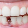 How real do dental implants look?