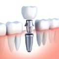 Why Now Is The Perfect Time To Consider Dental Implants In Mission Viejo