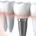 How dental implants are made?