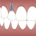 Transform Your Smile with Dental Implants in North Little Rock