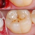 Do dental implants hurt?