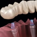 What is the best implant for teeth?
