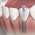 What You Need To Know Before Getting Dental Implants In New Jersey