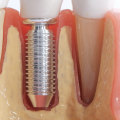 All You Need To Know About Getting Dental Implants In Cedar Park