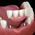 Restoring Confidence: Dental Implants In Hillsboro For A Natural-Looking Smile