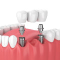 Dental Implants: The Modern Solution For Missing Teeth In Commerce City