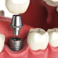 Which dental implants last the longest?