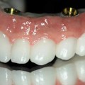 Cost And Timeframe Of Receiving Dental Implants In Mansfield, Texas