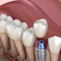 Why Are Dental Implants The Most Effective Treatment In Boerne For Tooth Loss And Damage