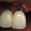 Why dental implants fail?