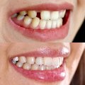 Transform Your Smile with Dental Implants and Orthodontics