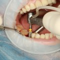 Dental Implants in Switzerland: Modern Solutions for Lasting Smiles