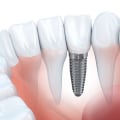 Choosing The Right Dentist For Dental Implants In Rockville, MD