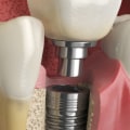 What To Expect When Getting Dental Implants In Ellsworth