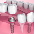 Why dental implants are important?