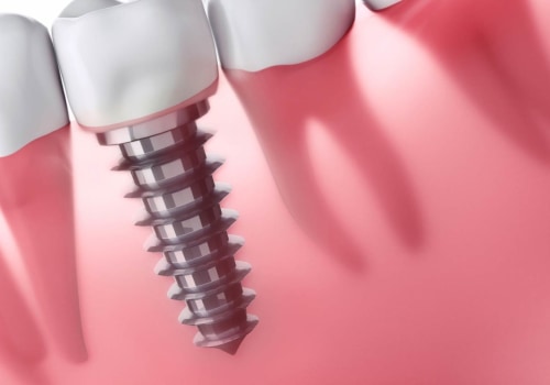 Can dental implants cause health issues?