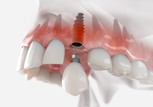 Can a failing implant be saved?