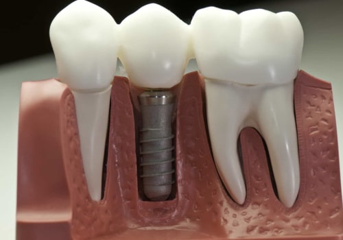 Are dental implants permanent?