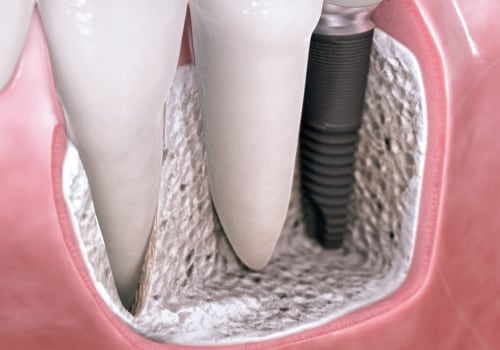 Are dental implants covered by insurance?