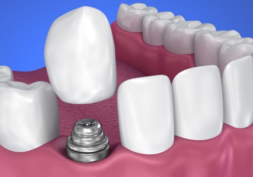 What is the most common cause of implant failure?