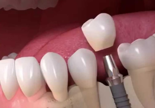 Where are dental implants the cheapest?