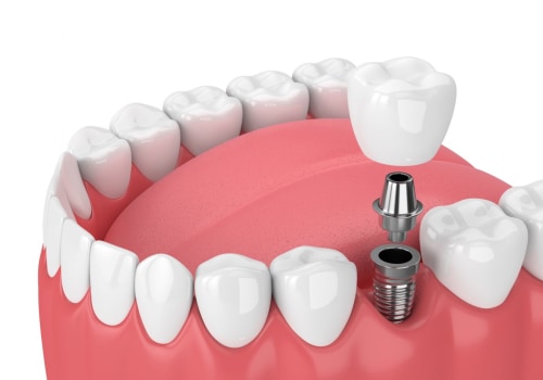 How long does a dental implant last?