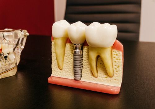 Say Goodbye To Gaps: How Dental Implants In Edmonds, WA Can Transform Your Smile