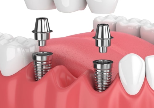 How are dental implants done step by step?