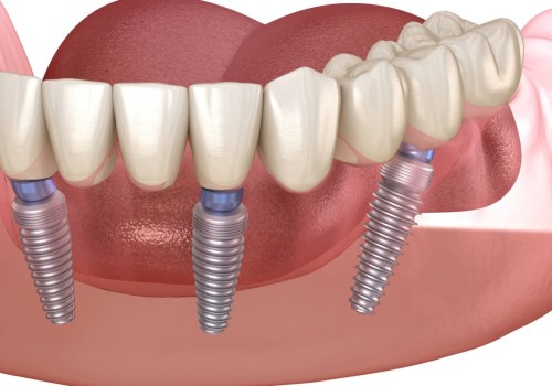 Why are full mouth implants so expensive?