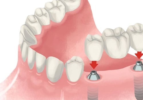 Which is a leading cause of dental implant failure?