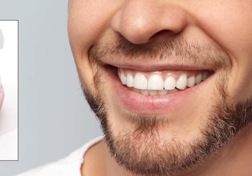 Are dental implants safe?