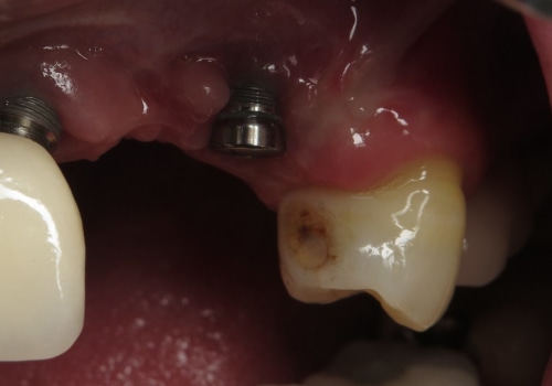 When dental implants fail?