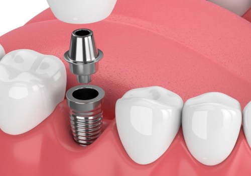 Can dental implants make you sick?