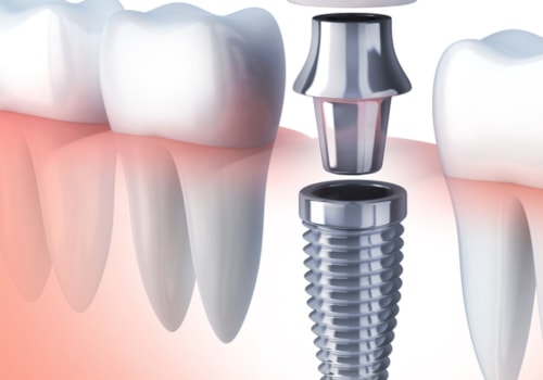 What You Need To Know About Dental Implants In Borger