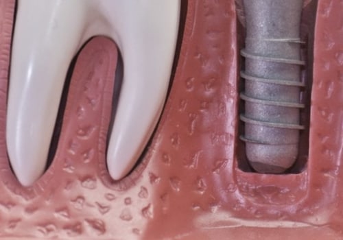 How long does it take for dental implants to stop hurting?