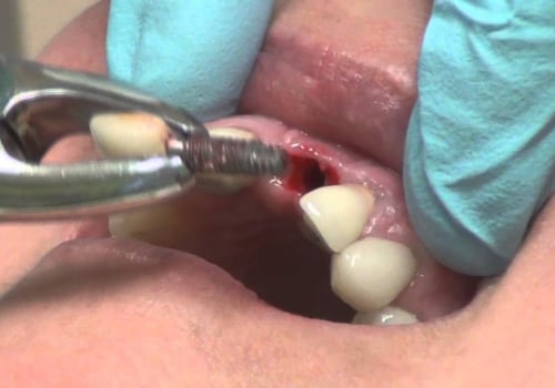 Can dental implants be removed?