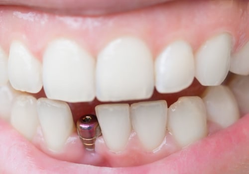 How real do dental implants look?