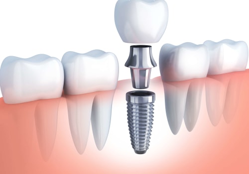 Why Now Is The Perfect Time To Consider Dental Implants In Mission Viejo