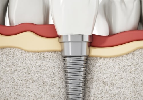 Discover The Benefits Of Dental Implants In Georgetown: Everything You Need To Know