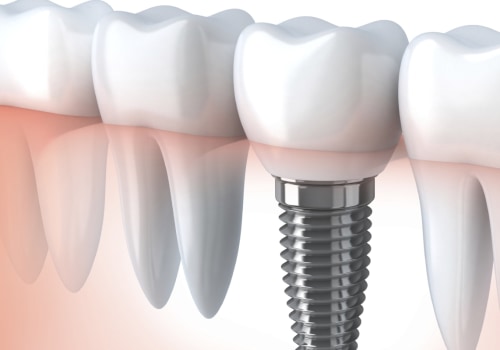 How dental implants are made?