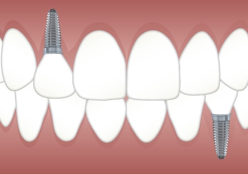 Transform Your Smile with Dental Implants in North Little Rock
